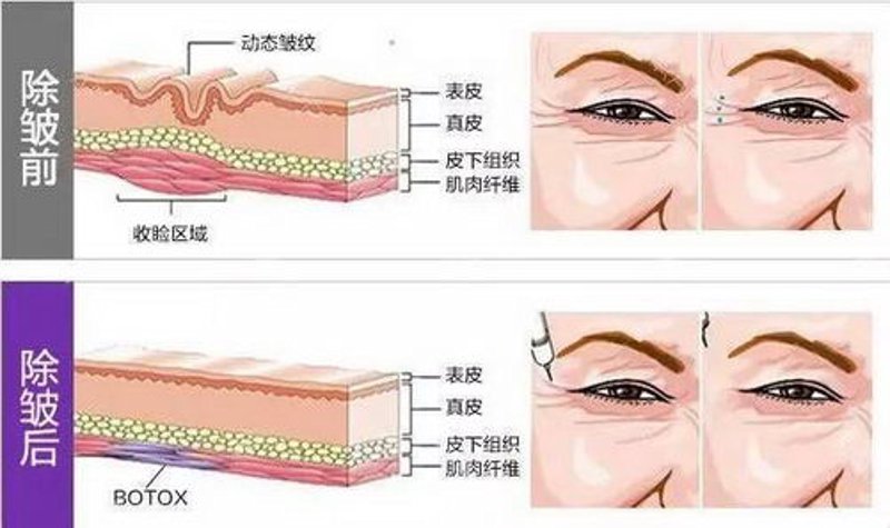 美丽之变——隆鼻手术成为现代美容的新风尚